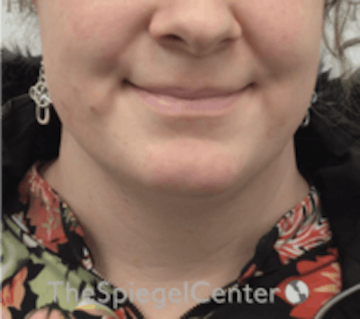 Mandible Contouring Before & After Gallery - Patient 157140203 - Image 1
