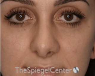 Rhinoplasty Before & After Gallery - Patient 157140202 - Image 4