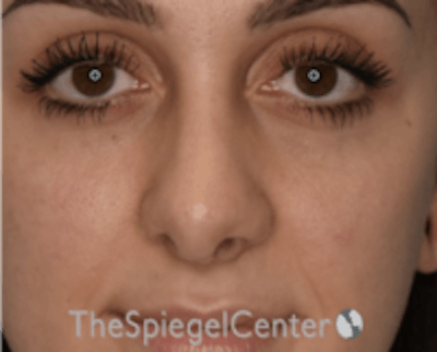 Rhinoplasty Before & After Gallery - Patient 157140202 - Image 4
