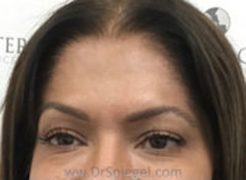Botox Browlift Before & After Gallery - Patient 157140194 - Image 2