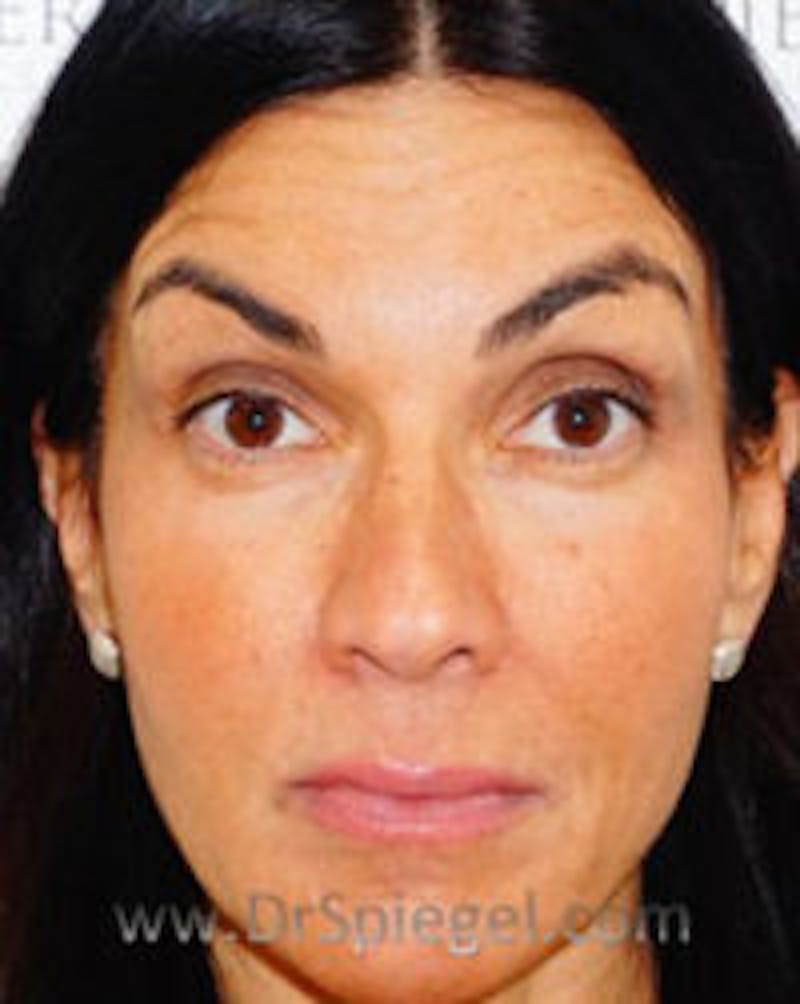 Botox / Dysport / Jeuveau / Xeomin Before & After Gallery - Patient 157140196 - Image 4