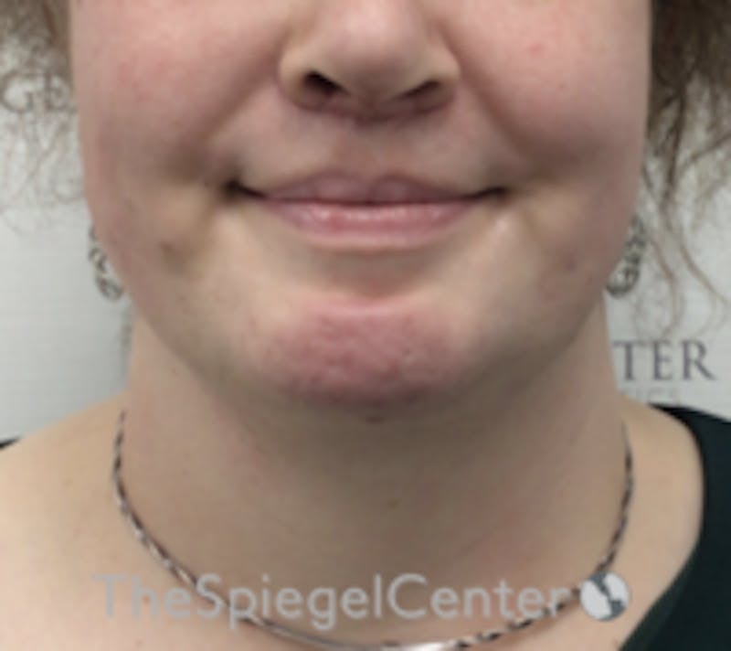 Mandible Contouring Before & After Gallery - Patient 157140203 - Image 2