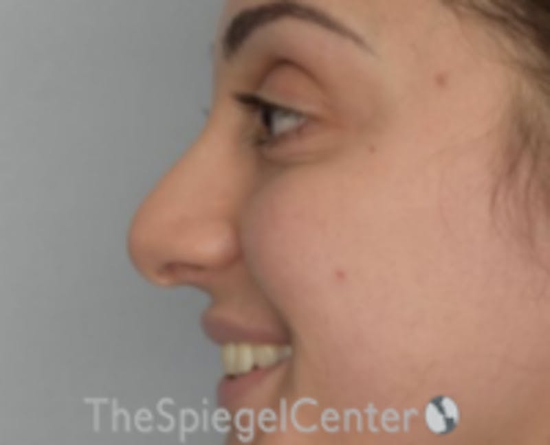 Rhinoplasty Before & After Gallery - Patient 157140202 - Image 1