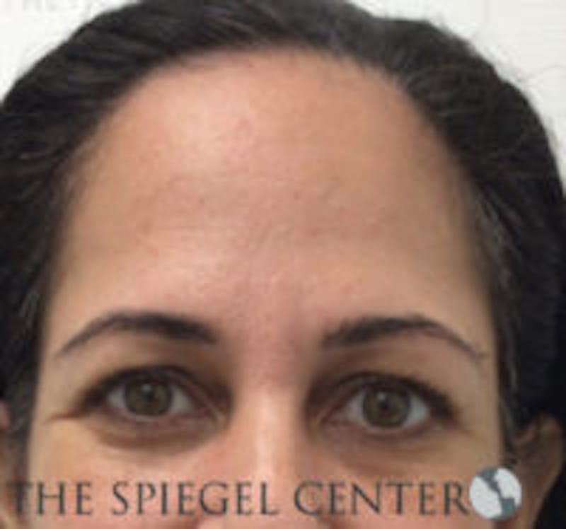 Botox Browlift Before & After Gallery - Patient 157140200 - Image 1