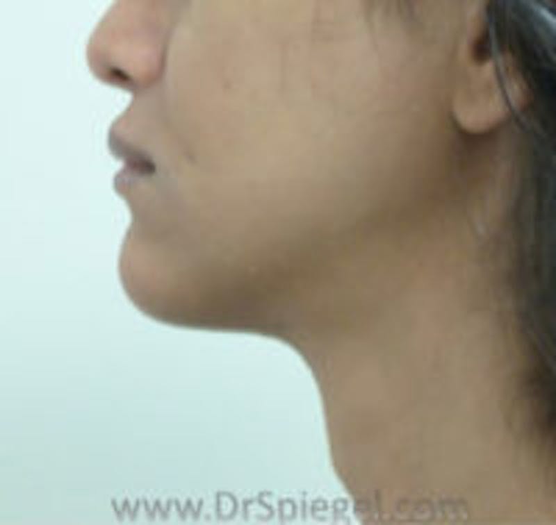 Trachea Shave Before & After Gallery - Patient 157140198 - Image 2