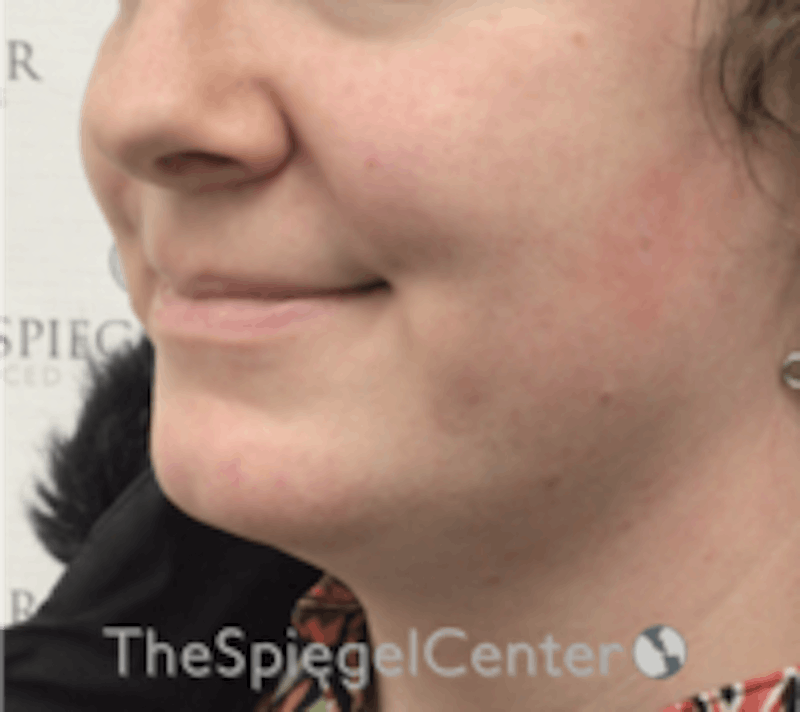 Mandible Contouring Before & After Gallery - Patient 157140203 - Image 3