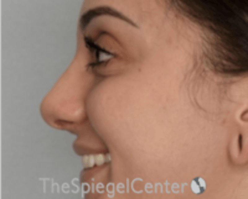 Rhinoplasty Before & After Gallery - Patient 157140202 - Image 2
