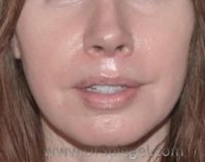 Lip Lift Before & After Gallery - Patient 157140201 - Image 2