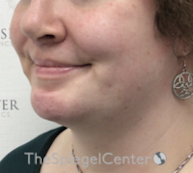 Mandible Contouring Before & After Gallery - Patient 157140203 - Image 4