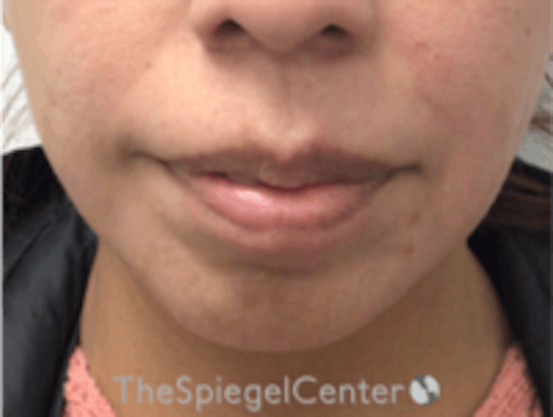 Chin Filler Before & After Gallery - Patient 157140211 - Image 1