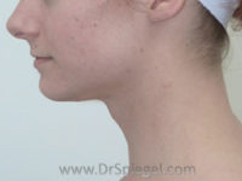 Trachea Shave Before & After Gallery - Patient 157140205 - Image 1