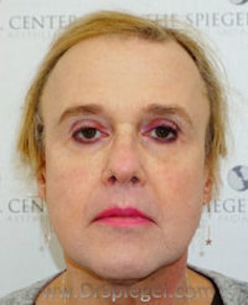FFS Before & After Gallery - Patient 157140213 - Image 1