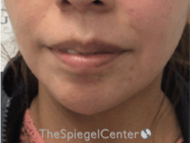 Chin Filler Before & After Gallery - Patient 157140211 - Image 2