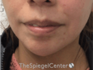 Chin Filler Before & After Gallery - Patient 157140211 - Image 2