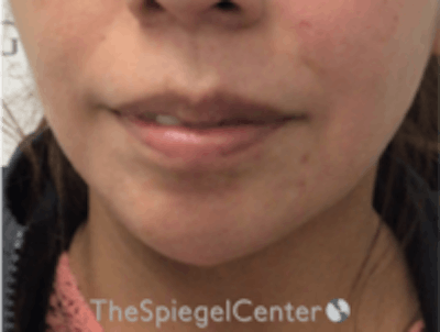 Chin Filler Before & After Gallery - Patient 157140211 - Image 2