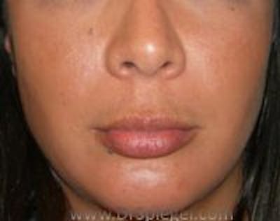 Lip Lift Before & After Gallery - Patient 157140207 - Image 1