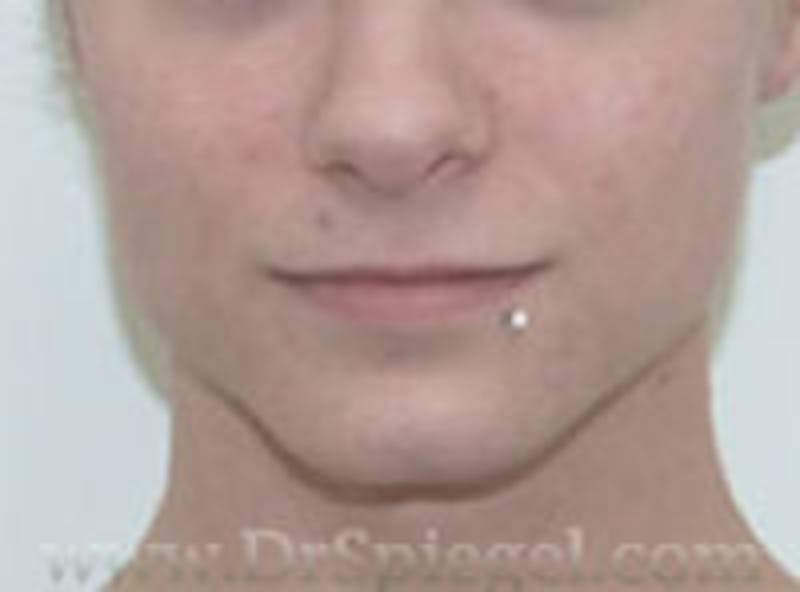 Mandible Contouring Before & After Gallery - Patient 157140209 - Image 1
