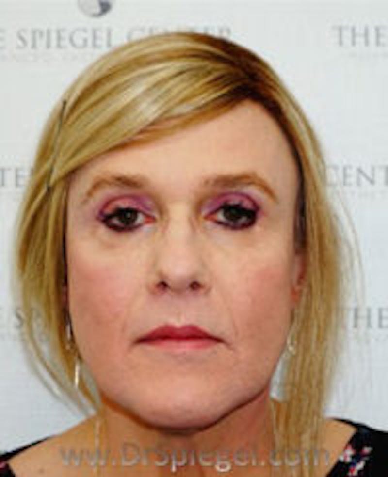 FFS Before & After Gallery - Patient 157140213 - Image 2