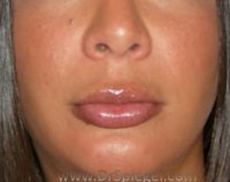 Lip Augmentation / Lip Implant / Lip Lift Before & After Gallery - Patient 157140207 - Image 2