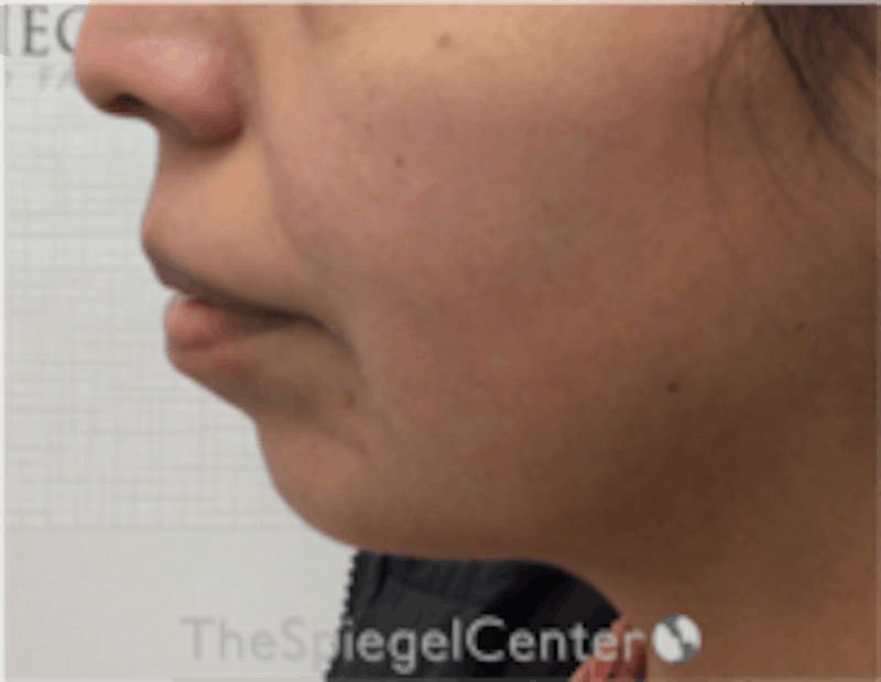 Chin Filler Before & After Gallery - Patient 157140211 - Image 3