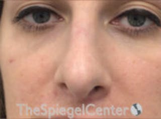 Rhinoplasty Before & After Gallery - Patient 157140214 - Image 4