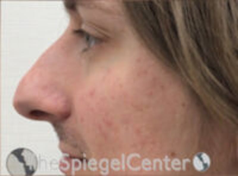 Rhinoplasty Before & After Gallery - Patient 157140214 - Image 1