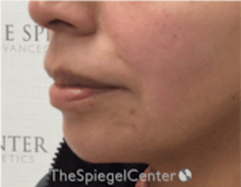 Chin Filler Before & After Gallery - Patient 157140211 - Image 4