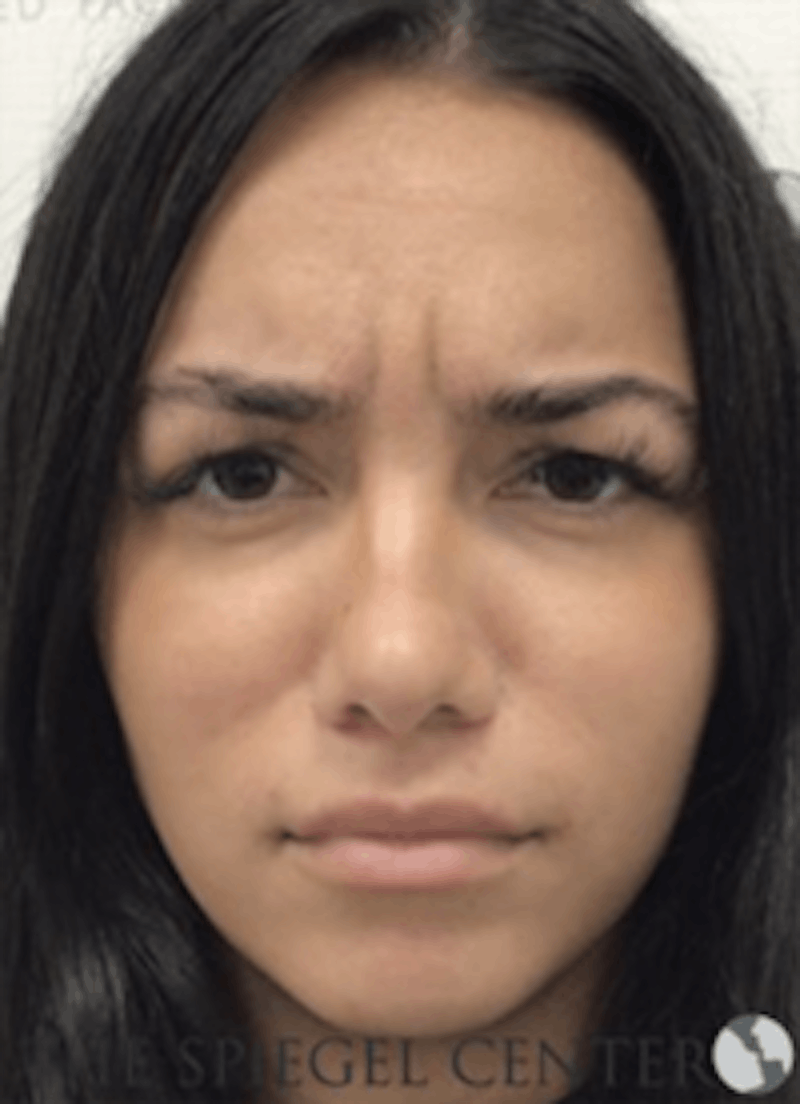 Botox / Dysport / Jeuveau / Xeomin Before & After Gallery - Patient 157140224 - Image 1