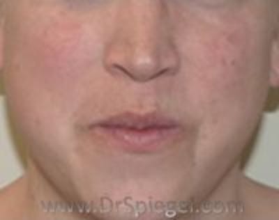 Lip Lift Before & After Gallery - Patient 157140215 - Image 1