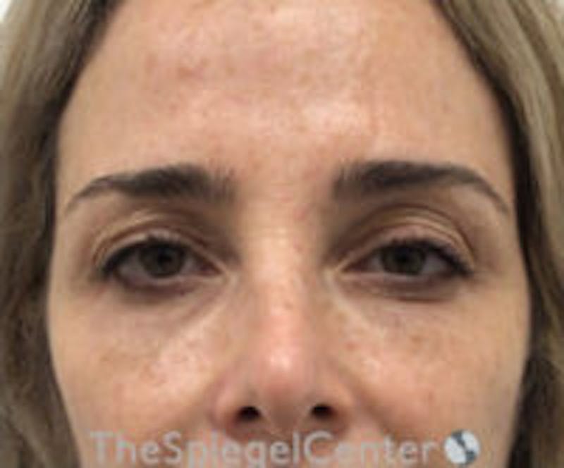 Botox Browlift Before & After Gallery - Patient 157140216 - Image 1