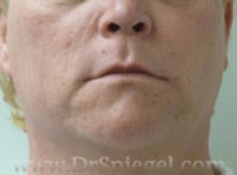 Mandible Contouring Before & After Gallery - Patient 157140217 - Image 1