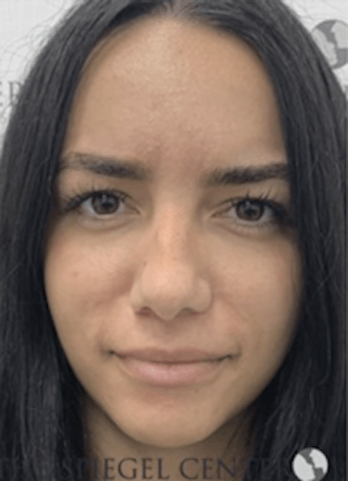 Botox / Dysport / Jeuveau / Xeomin Before & After Gallery - Patient 157140224 - Image 2