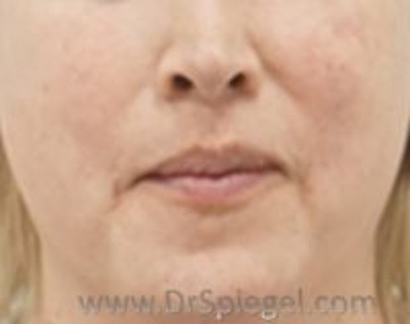 Lip Augmentation / Lip Implant / Lip Lift Before & After Gallery - Patient 157140215 - Image 2