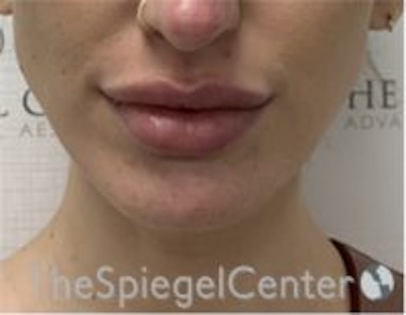 Chin Filler Before & After Gallery - Patient 157140223 - Image 1