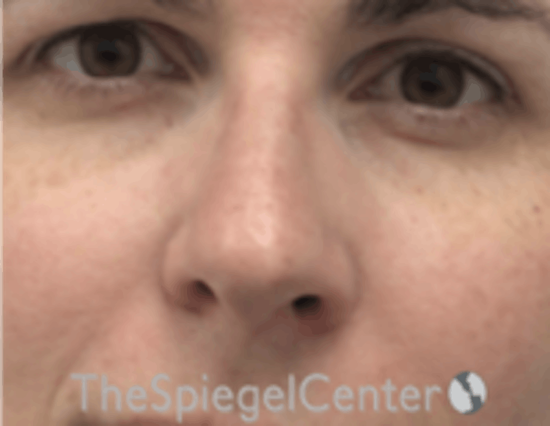 Rhinoplasty Before & After Gallery - Patient 157140229 - Image 3