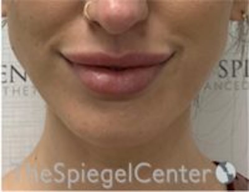 Chin Filler Before & After Gallery - Patient 157140223 - Image 2