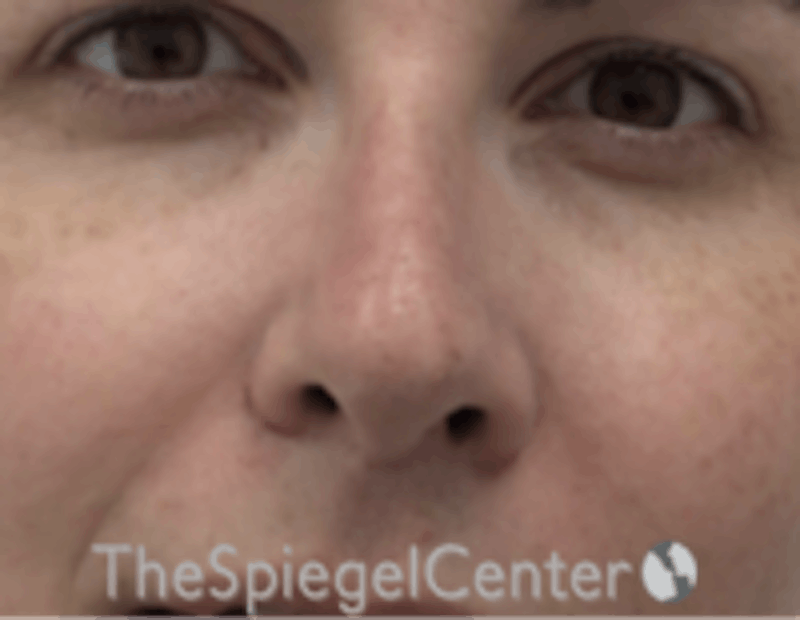 Rhinoplasty Before & After Gallery - Patient 157140229 - Image 4