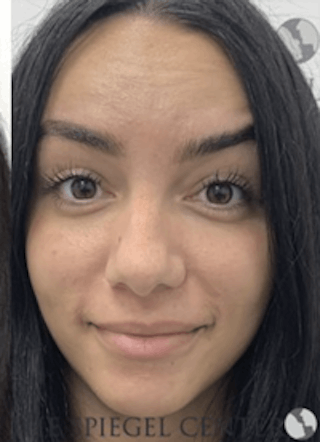 Botox / Dysport / Jeuveau / Xeomin Before & After Gallery - Patient 157140224 - Image 4