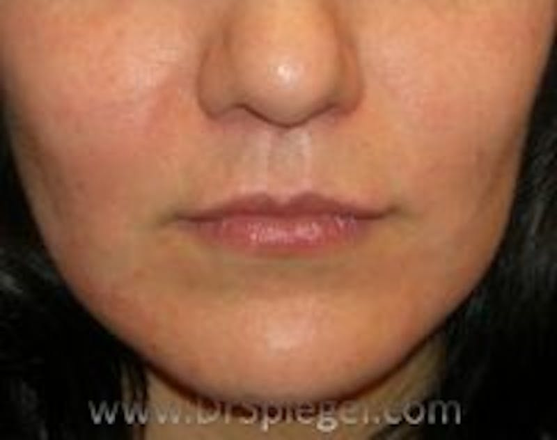 Lip Augmentation / Lip Implant / Lip Lift Before & After Gallery - Patient 157140221 - Image 2
