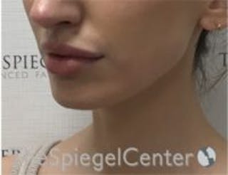 Chin Filler Before & After Gallery - Patient 157140223 - Image 4