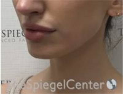 Chin Filler Before & After Gallery - Patient 157140223 - Image 4