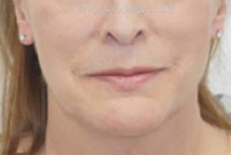 Mandible Contouring Before & After Gallery - Patient 157140225 - Image 2