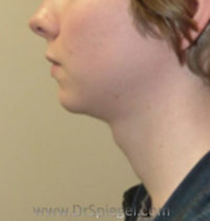 Trachea Shave Before & After Gallery - Patient 157140228 - Image 1