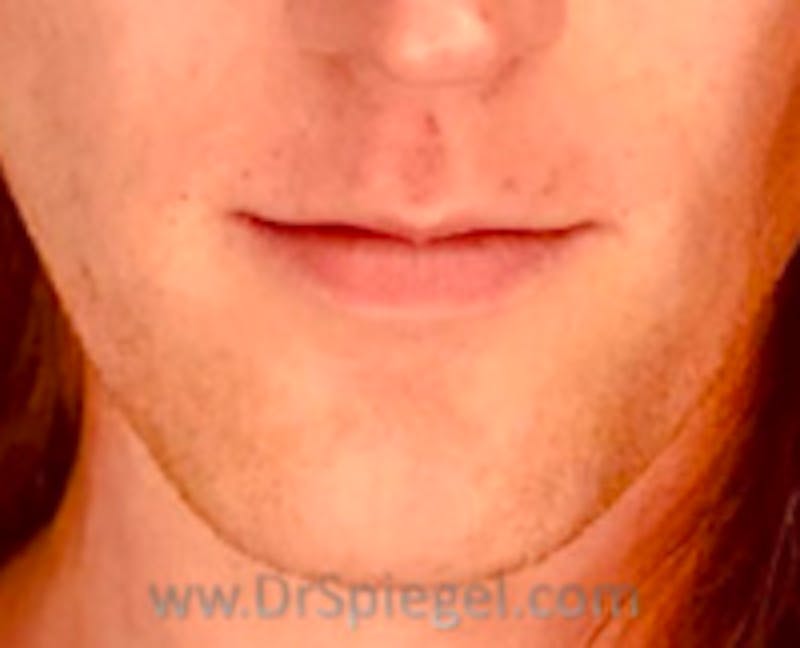 Lip Augmentation / Lip Implant / Lip Lift Before & After Gallery - Patient 157140232 - Image 1