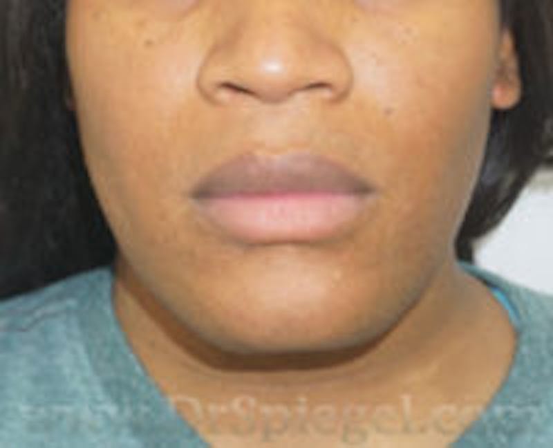 Mandible Contouring Before & After Gallery - Patient 157140231 - Image 1