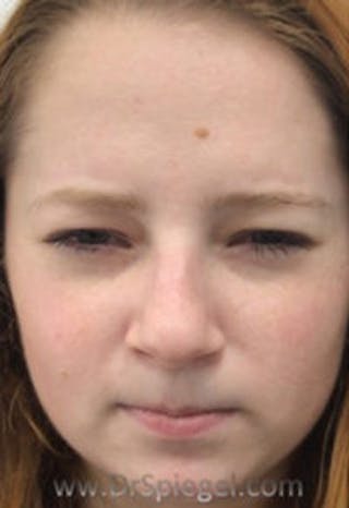 Botox / Dysport / Jeuveau / Xeomin Before & After Gallery - Patient 157140236 - Image 2