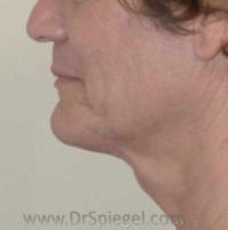 Trachea Shave Before & After Gallery - Patient 157140234 - Image 1