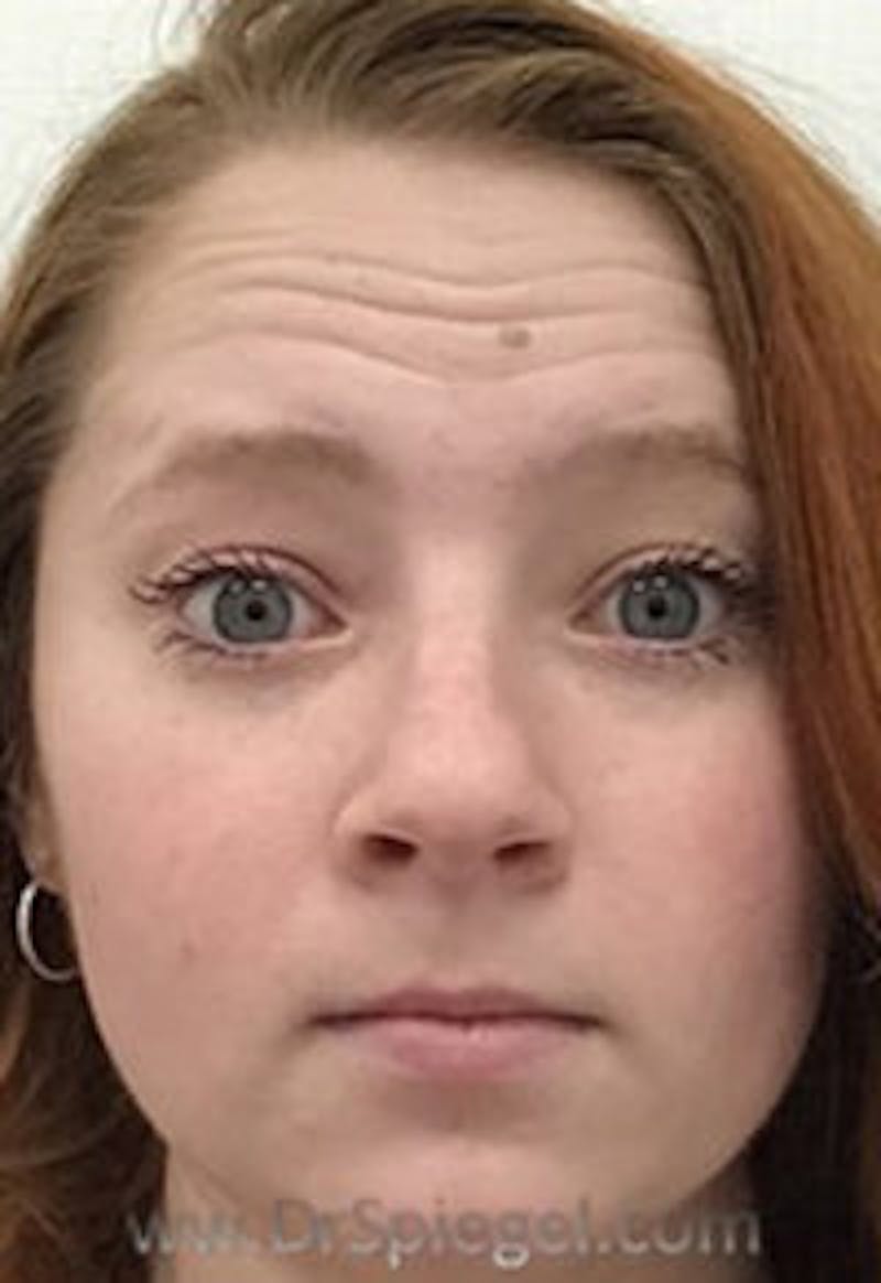 Botox / Dysport / Jeuveau / Xeomin Before & After Gallery - Patient 157140236 - Image 3