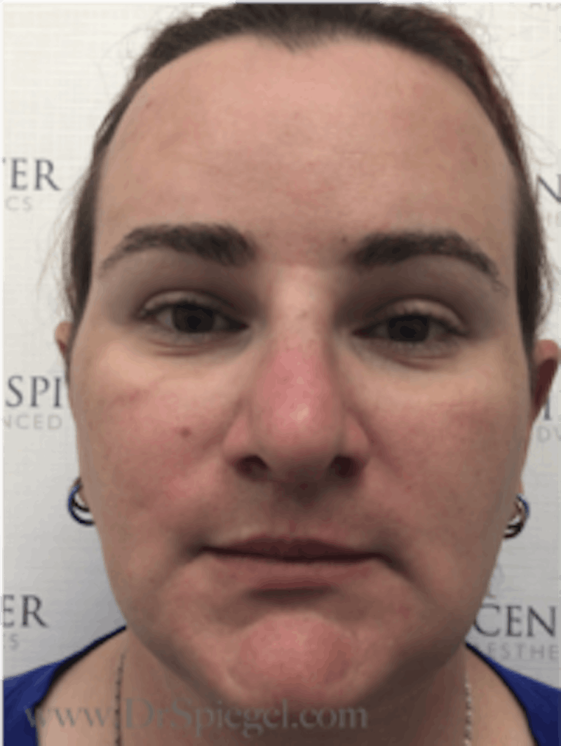 FFS Before & After Gallery - Patient 157140241 - Image 2