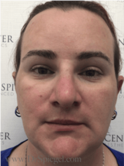 FFS Before & After Gallery - Patient 157140241 - Image 2